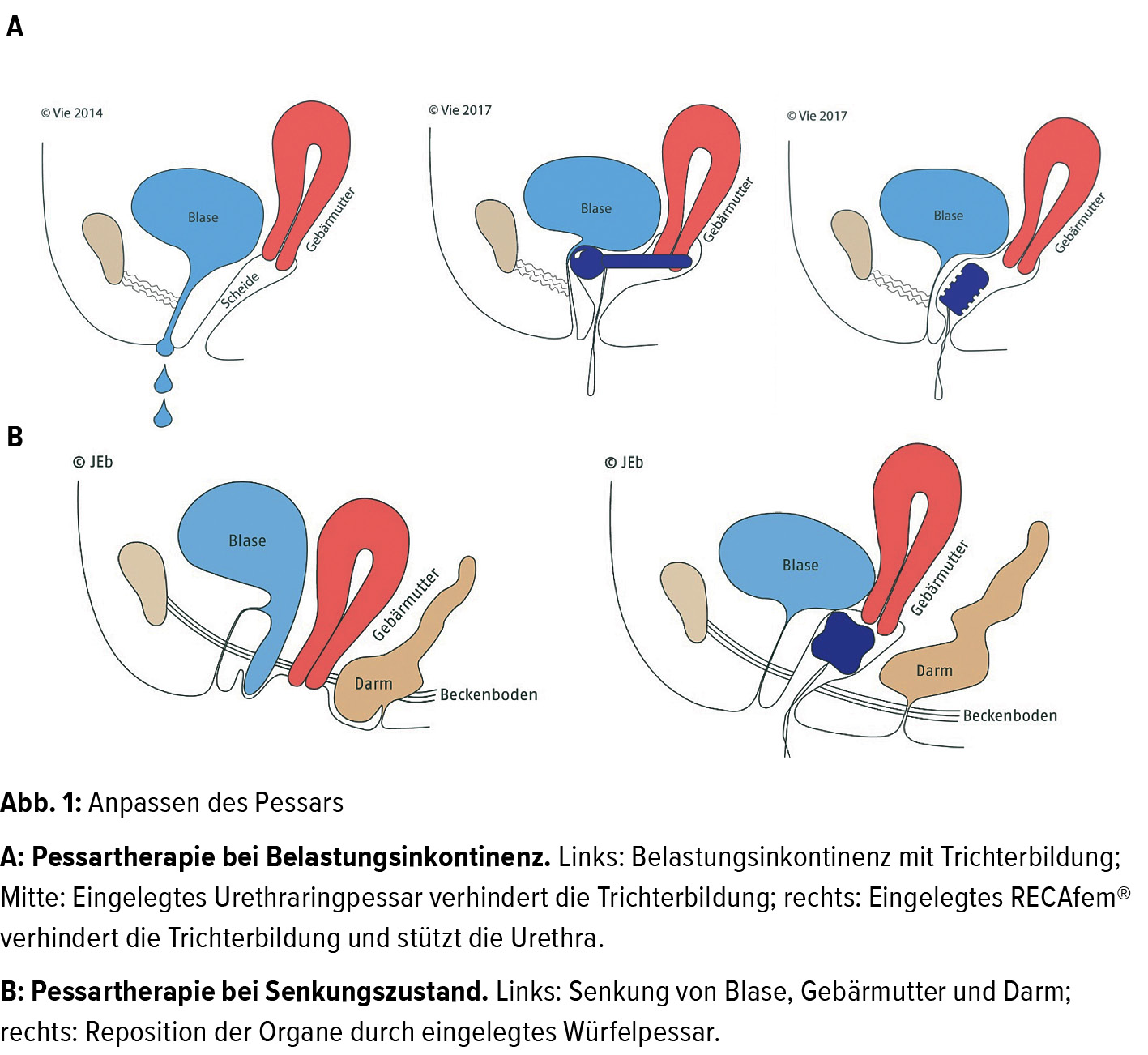 Was Ist Ein Pessar - Captions Trendy